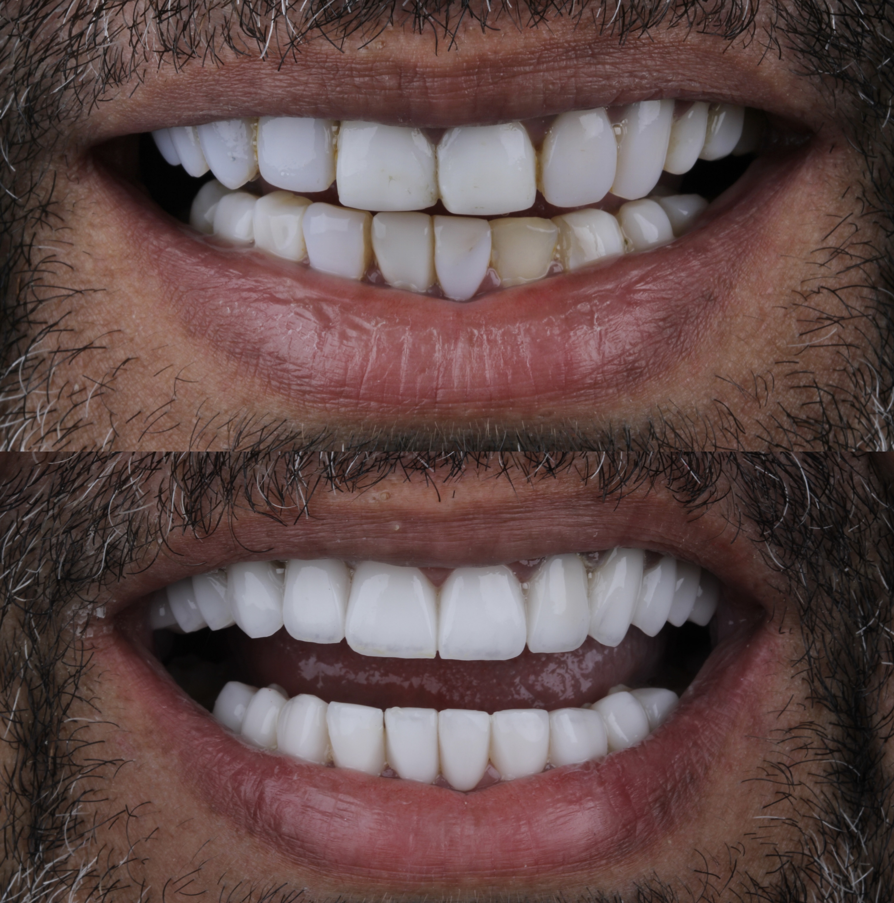 Reabilitação com lentes – alinhamento e harmonia