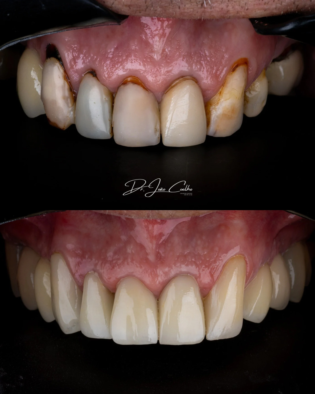 Lentes com efeito natural – textura e brilho controlados