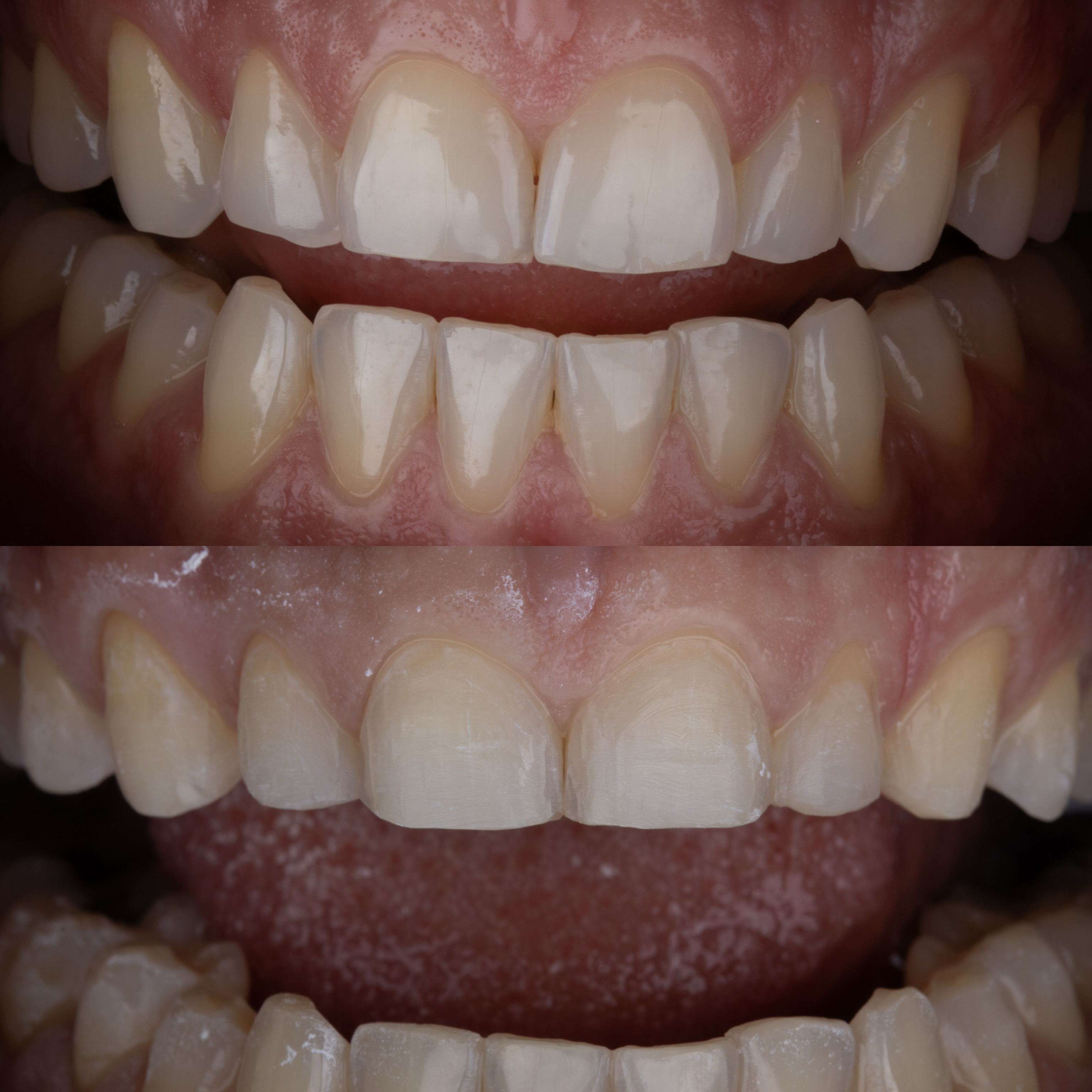 Exemplo ilustrativo de desgaste mínimo para lentes